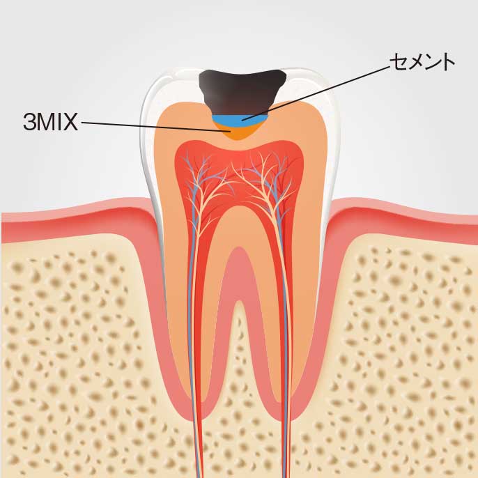 3mix法の解説イラスト