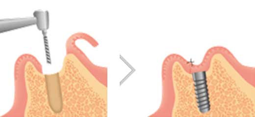 インプラントの1次手術