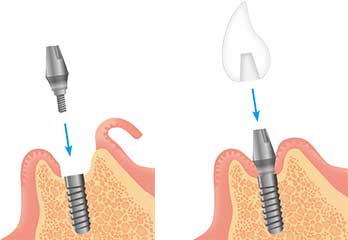 インプラント2次手術