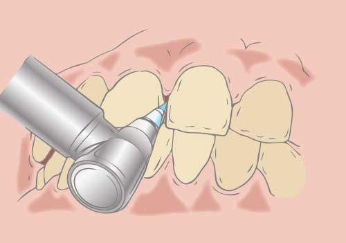 歯と歯の隙間の汚れを専用の器具を使用して除去