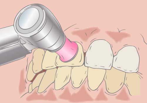 歯の表面を、専用の器具と薬剤を用いて磨く