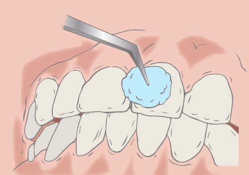 歯面にフッ素を塗布