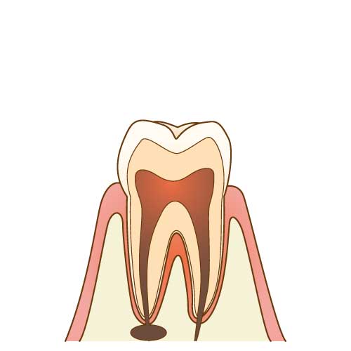虫歯が進行