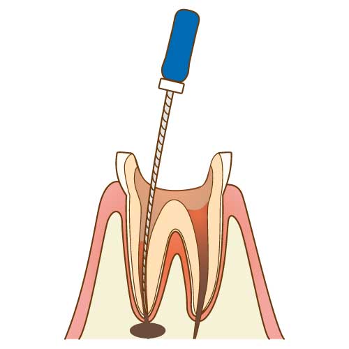 感染した歯髄や神経