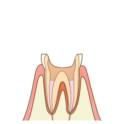 菌がなくなるまで消毒