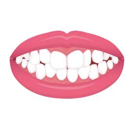 イラスト図：叢生（そうせい）