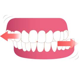 イラスト図：歯ぎしり