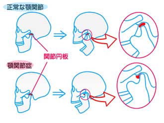 顎関節症の解説イラスト