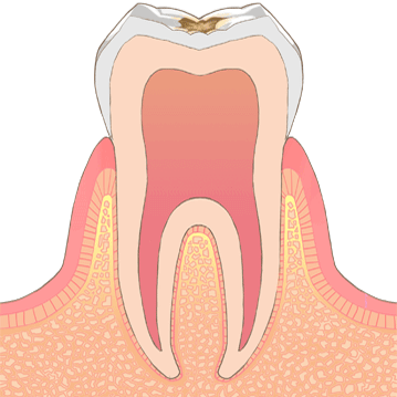 むし歯の進行C1、歯に穴が開いたイラスト
