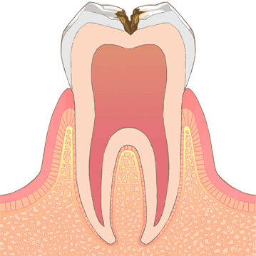 むし歯の進行C2、象牙質に虫歯が達したイラスト
