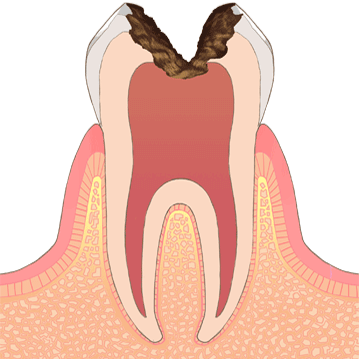 むし歯の進行C3、虫歯が歯髄（神経）にまで達したイラスト