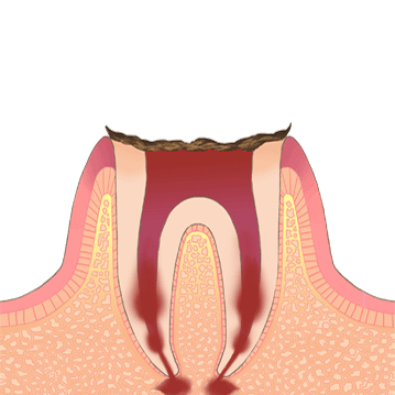 むし歯の進行C4、歯髄がなくなったイラスト